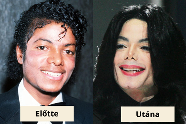 Michael Jackson plasztika