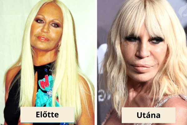 Donatella Versace plasztika