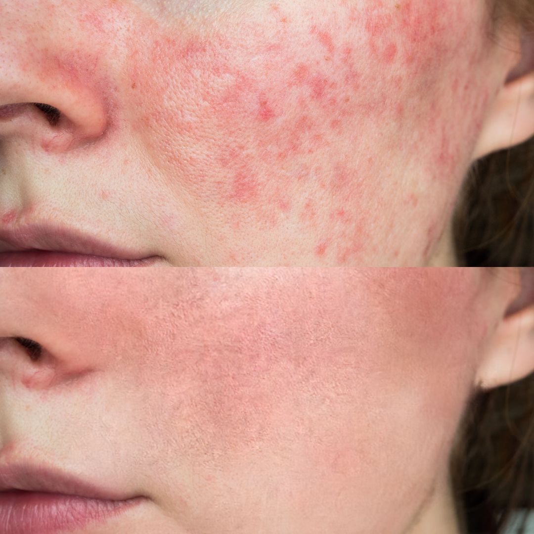 CO2 frakcionált lézeres arc kezelés – orca