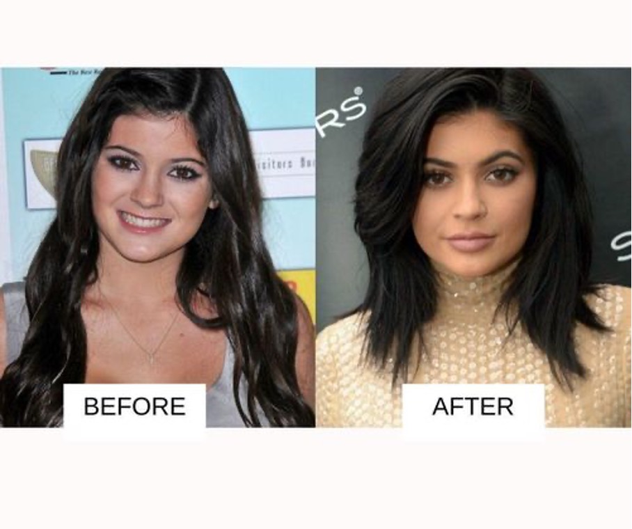 Kylie Jenner előtte utána Kylie Jenner előtte utána